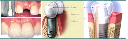 Dental Implant replacement of a single tooth